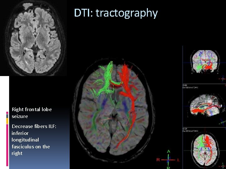 DTI: tractography Right frontal lobe seizure Decrease fibers ILF: inferior longitudinal fasciculus on the