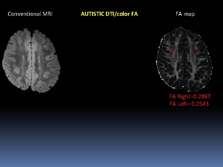 Conventional MRI AUTISTIC DTI/color FA FA map FA Right=0. 2867 FA Left= 0. 2543