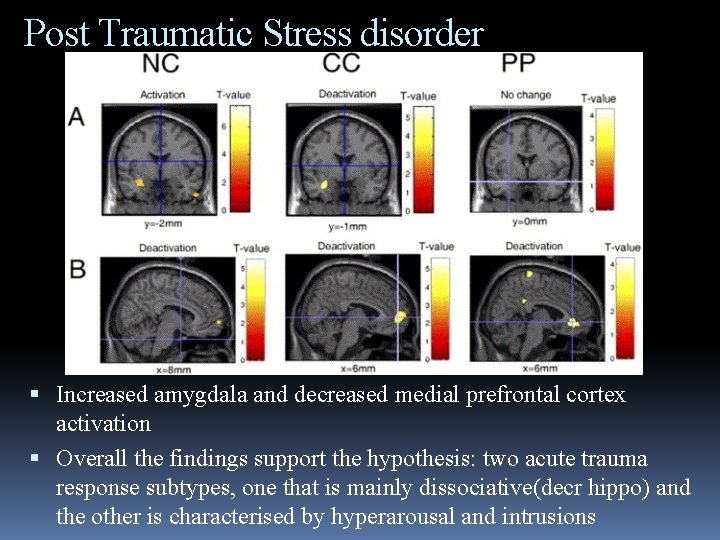 Post Traumatic Stress disorder Increased amygdala and decreased medial prefrontal cortex activation Overall the