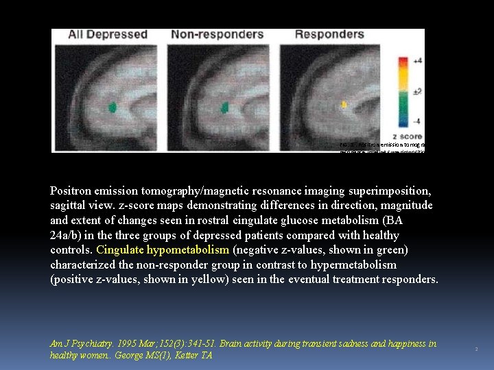 FIG. 1. Positron emission tomography/magnetic resonance imaging superimposition, sagittal view. z-score maps demonstrating differences