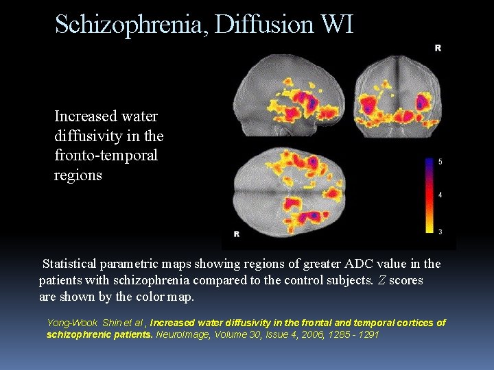 Schizophrenia, Diffusion WI Increased water diffusivity in the fronto-temporal regions Statistical parametric maps showing