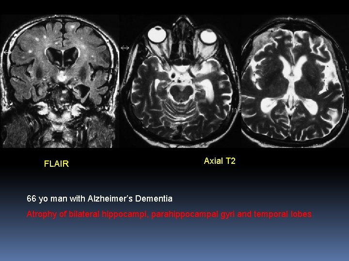 FLAIR Axial T 2 66 yo man with Alzheimer’s Dementia Atrophy of bilateral hippocampi,