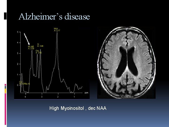 Alzheimer’s disease High Myoinositol , dec NAA 