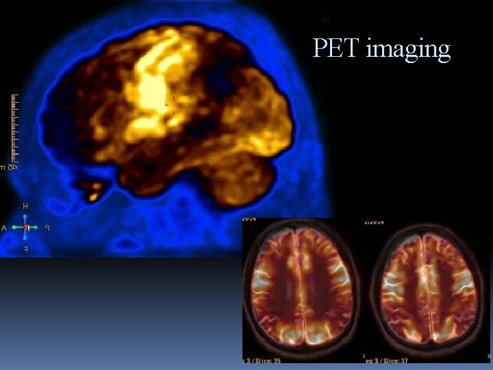PET imaging 53 y. o. memory loss 