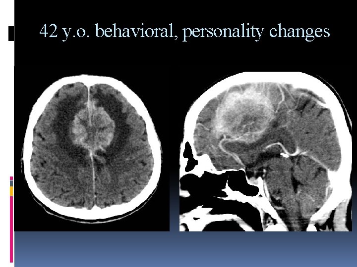 42 y. o. behavioral, personality changes 