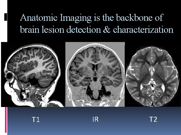 Anatomic Imaging is the backbone of brain lesion detection & characterization T 1 IR