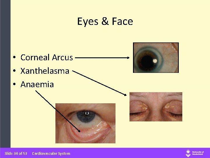 Eyes & Face • Corneal Arcus • Xanthelasma • Anaemia Slide 34 of 53