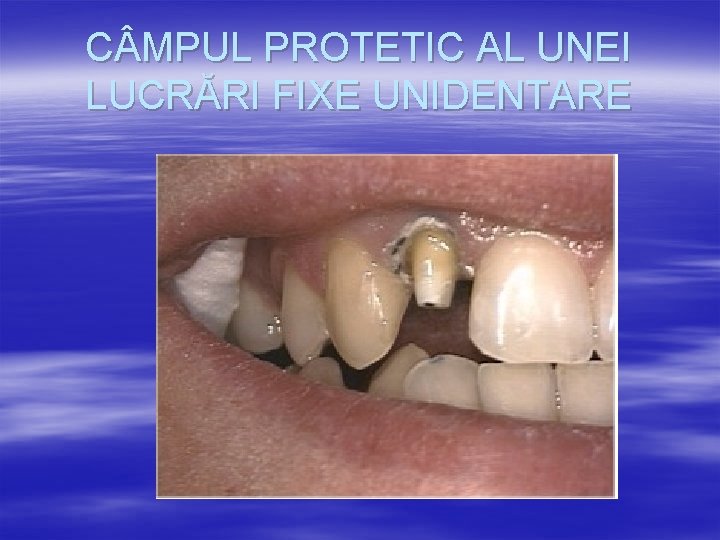 C MPUL PROTETIC AL UNEI LUCRĂRI FIXE UNIDENTARE 