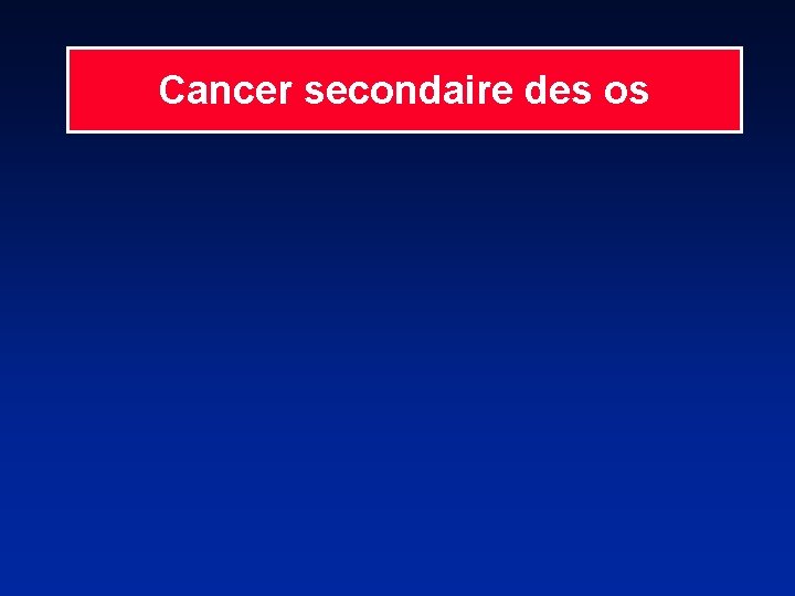Cancer secondaire des os 