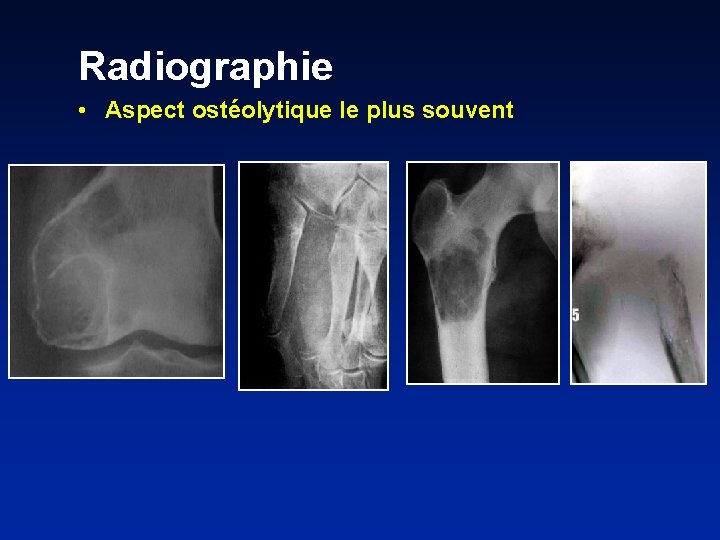 Radiographie • Aspect ostéolytique le plus souvent 