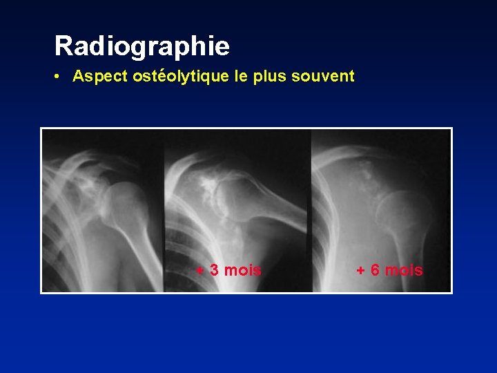 Radiographie • Aspect ostéolytique le plus souvent + 3 mois + 6 mois 