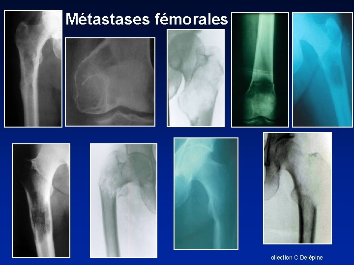 Métastases fémorales ollection C Delépine 