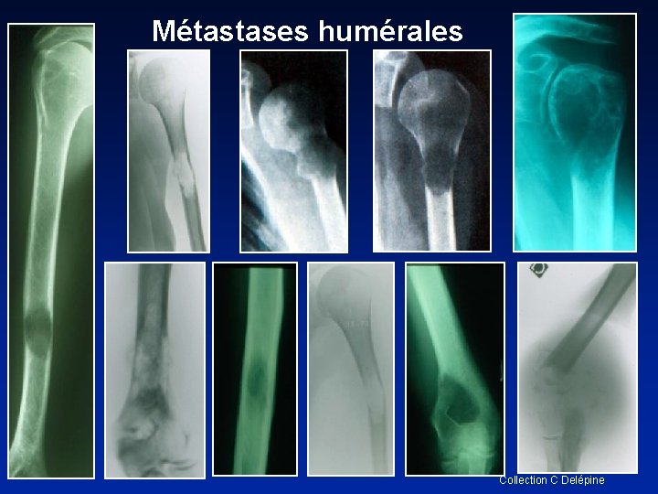 Métastases humérales Collection C Delépine 