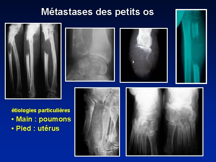 Métastases des petits os étiologies particulières • Main : poumons • Pied : utérus