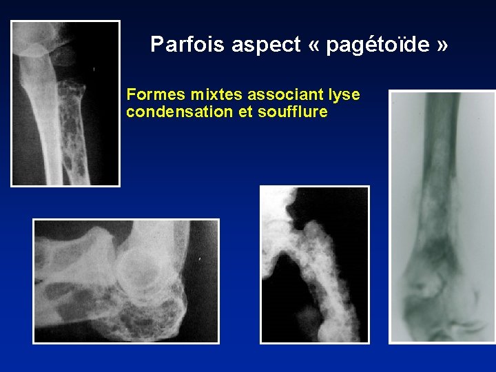 Parfois aspect « pagétoïde » Formes mixtes associant lyse condensation et soufflure 