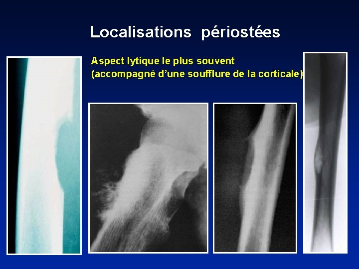 Localisations périostées Aspect lytique le plus souvent (accompagné d’une soufflure de la corticale) 