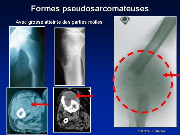 Formes pseudosarcomateuses Avec grosse atteinte des parties molles Collection C Delépine 