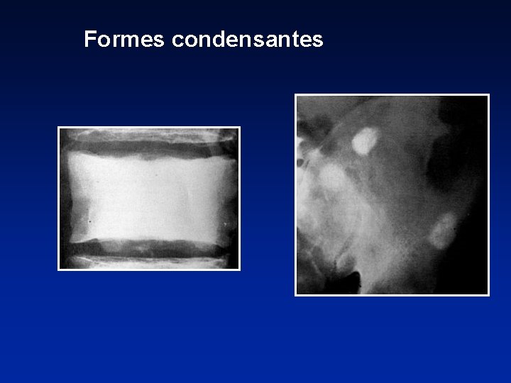 Formes condensantes 