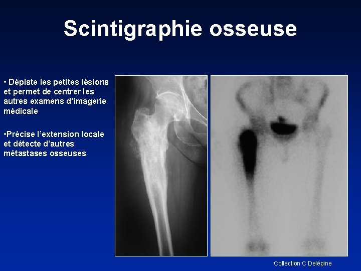 Scintigraphie osseuse • Dépiste les petites lésions et permet de centrer les autres examens
