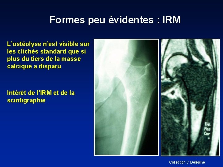 Formes peu évidentes : IRM L’ostéolyse n’est visible sur les clichés standard que si