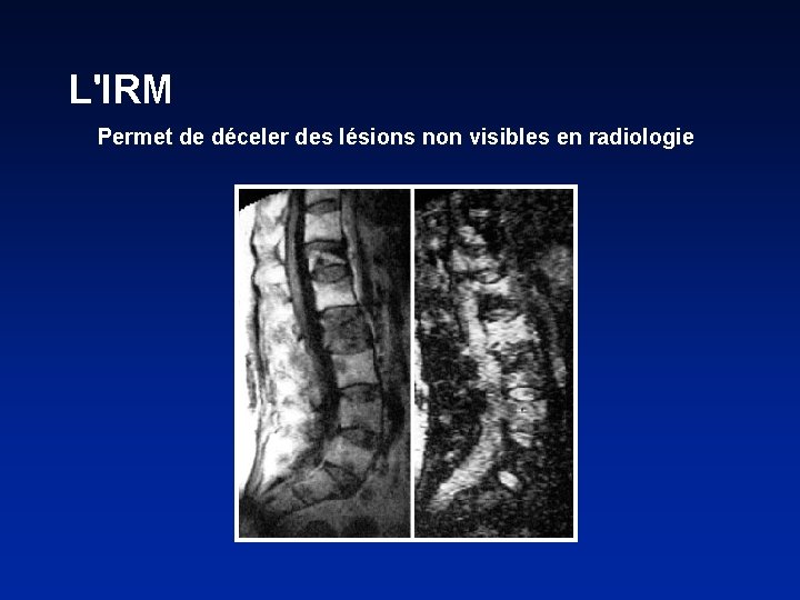 L'IRM Permet de déceler des lésions non visibles en radiologie 