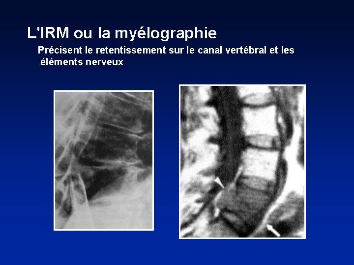 L'IRM ou la myélographie Précisent le retentissement sur le canal vertébral et les éléments