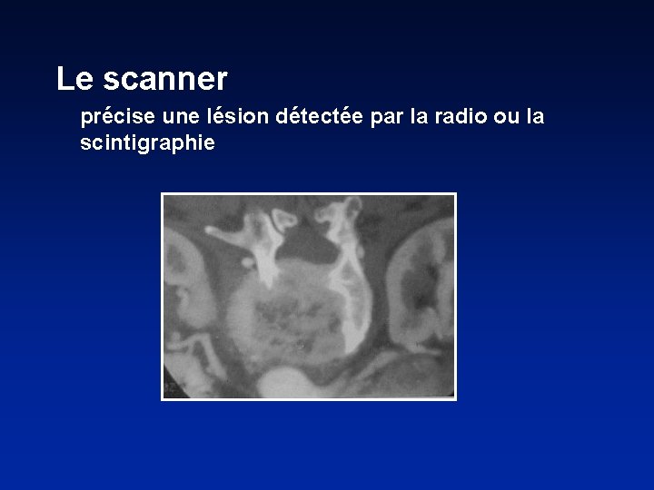 Le scanner précise une lésion détectée par la radio ou la scintigraphie 