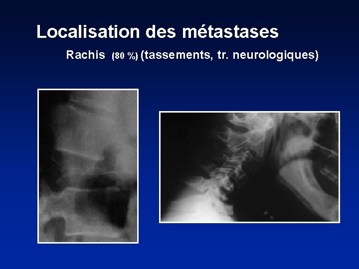 Localisation des métastases Rachis (80 %) (tassements, tr. neurologiques) 