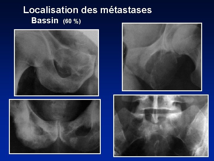 Localisation des métastases Bassin (60 %) 