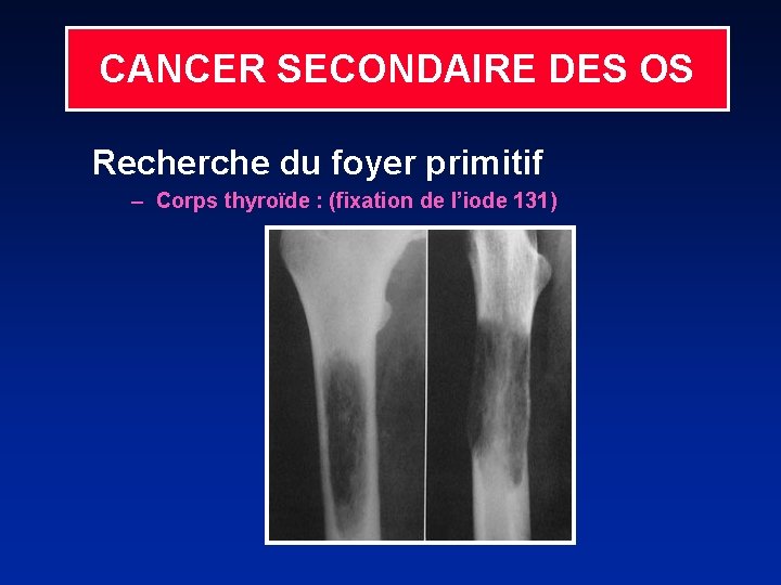 CANCER SECONDAIRE DES OS Recherche du foyer primitif – Corps thyroïde : (fixation de
