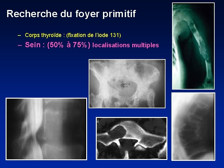 Recherche du foyer primitif – Corps thyroïde : (fixation de l’iode 131) – Sein