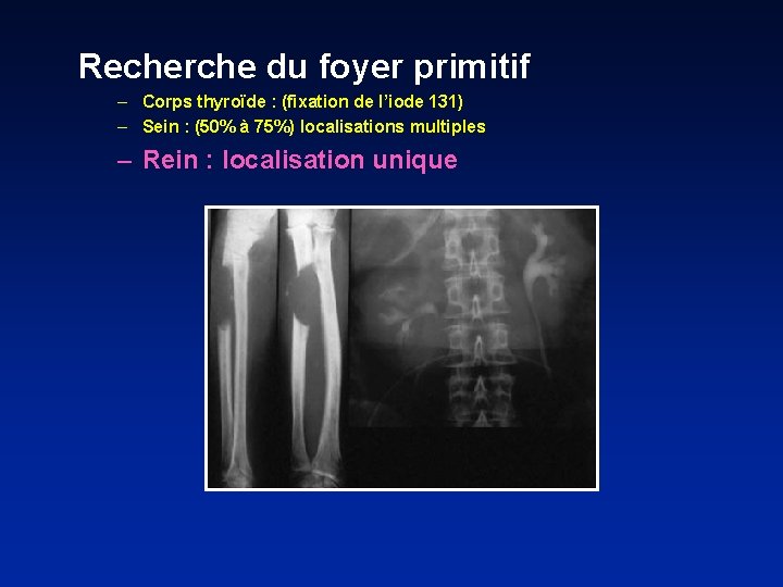 Recherche du foyer primitif – Corps thyroïde : (fixation de l’iode 131) – Sein