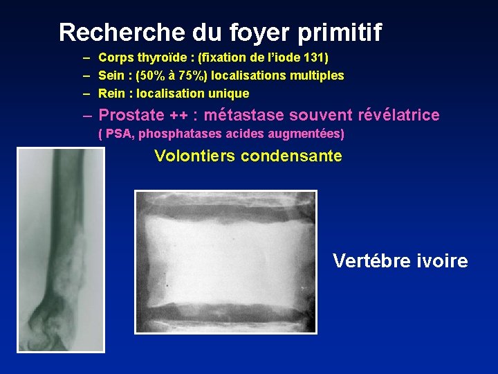 Recherche du foyer primitif – Corps thyroïde : (fixation de l’iode 131) – Sein
