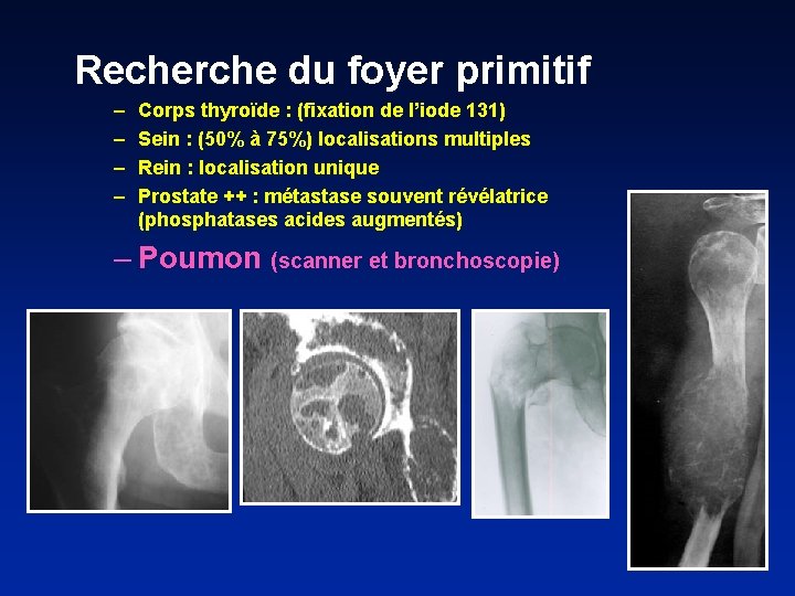 Recherche du foyer primitif – – Corps thyroïde : (fixation de l’iode 131) Sein