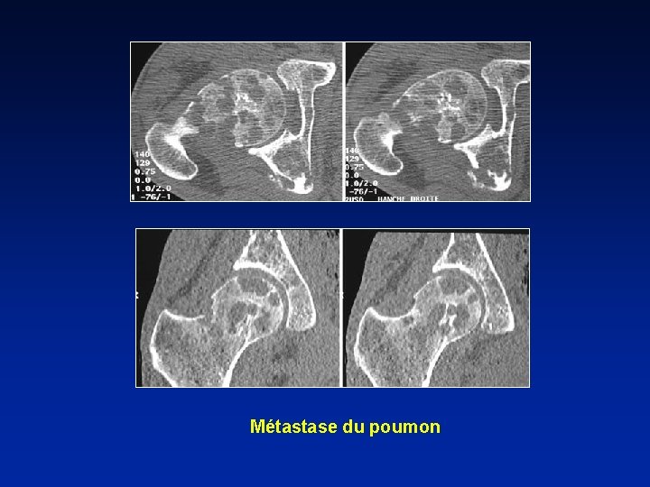 Métastase du poumon 