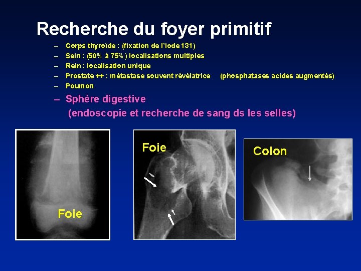 Recherche du foyer primitif – – – Corps thyroïde : (fixation de l’iode 131)