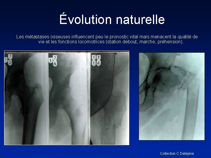 Évolution naturelle Les métastases osseuses influencent peu le pronostic vital mais menacent la qualité