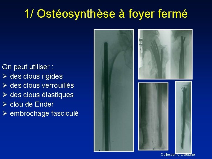1/ Ostéosynthèse à foyer fermé On peut utiliser : Ø des clous rigides Ø