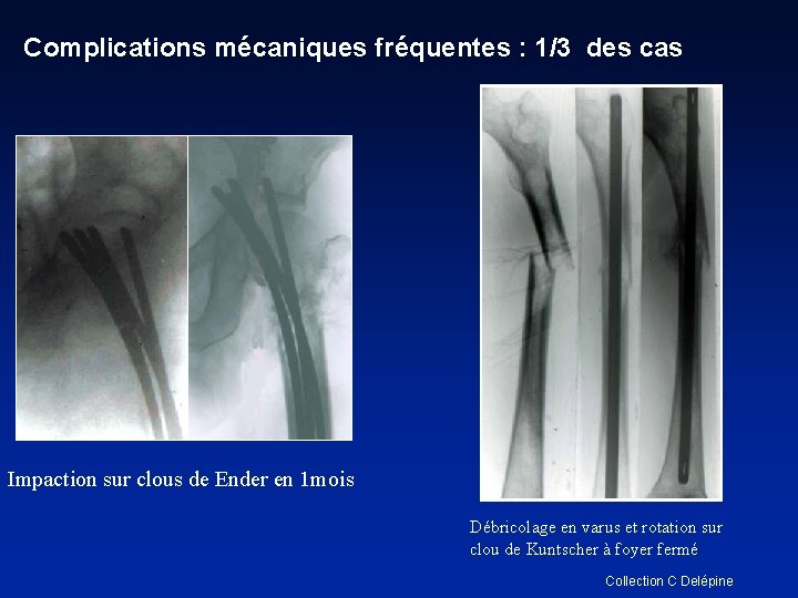 Complications mécaniques fréquentes : 1/3 des cas Impaction sur clous de Ender en 1
