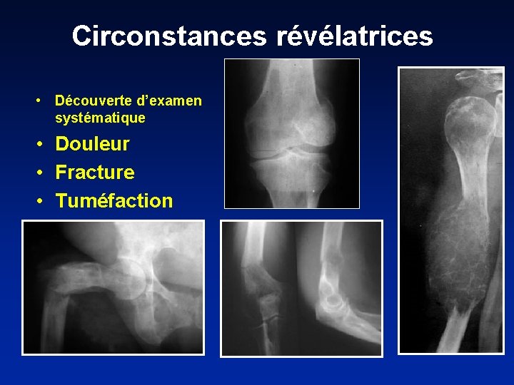 Circonstances révélatrices • Découverte d’examen systématique • Douleur • Fracture • Tuméfaction 
