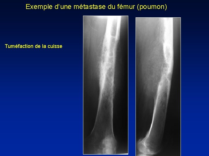 Exemple d’une métastase du fémur (poumon) Tuméfaction de la cuisse 