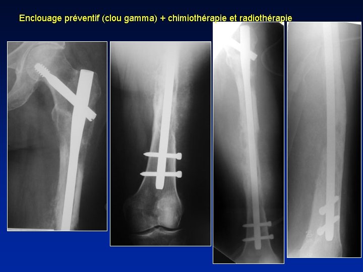 Enclouage préventif (clou gamma) + chimiothérapie et radiothérapie 