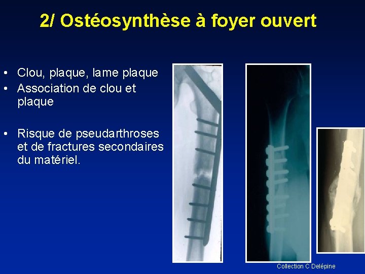 2/ Ostéosynthèse à foyer ouvert • Clou, plaque, lame plaque • Association de clou