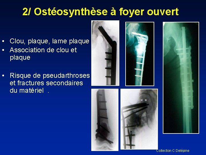 2/ Ostéosynthèse à foyer ouvert • Clou, plaque, lame plaque • Association de clou