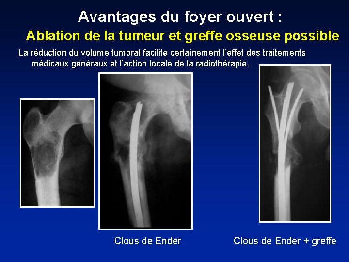 Avantages du foyer ouvert : Ablation de la tumeur et greffe osseuse possible La