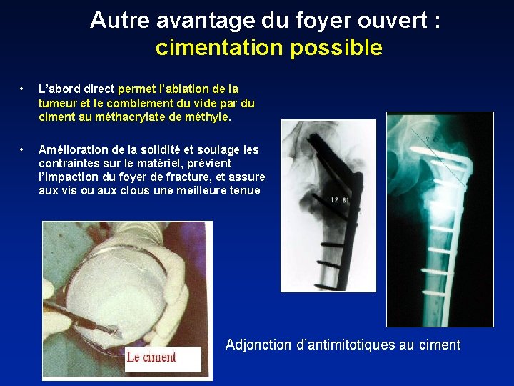 Autre avantage du foyer ouvert : cimentation possible • L’abord direct permet l’ablation de