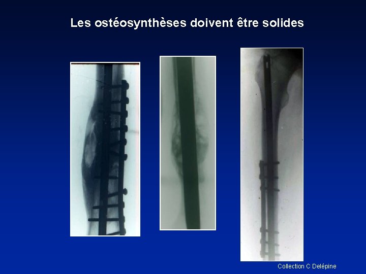 Les ostéosynthèses doivent être solides Collection C Delépine 