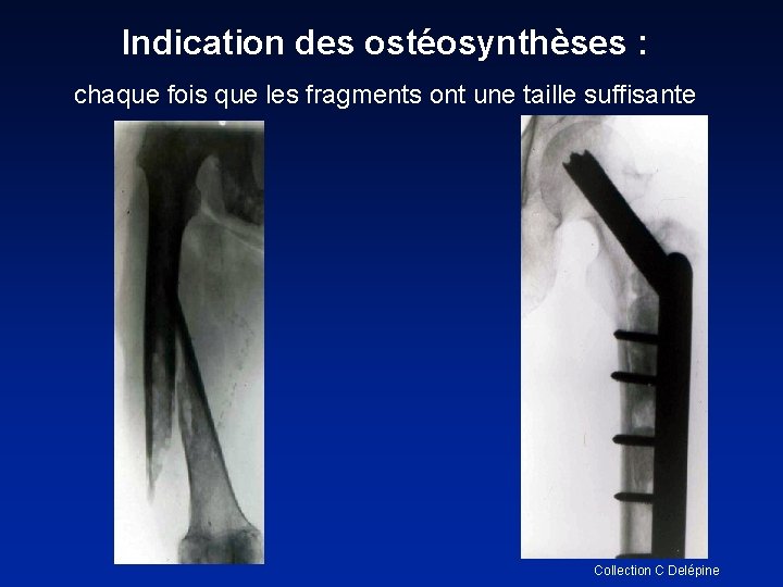 Indication des ostéosynthèses : chaque fois que les fragments ont une taille suffisante Collection