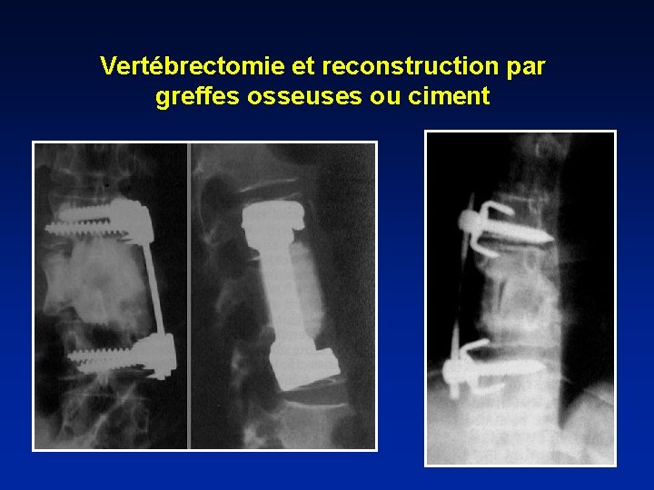 Vertébrectomie et reconstruction par greffes osseuses ou ciment 