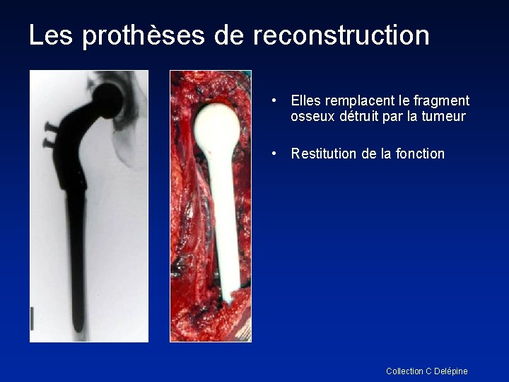 Les prothèses de reconstruction • Elles remplacent le fragment osseux détruit par la tumeur